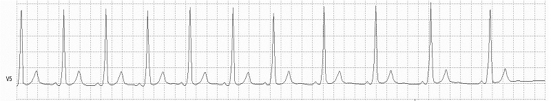 Wolff-Parkinson-White (WPW) Rhythm Strip_fig2